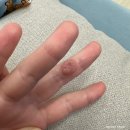 아이 손가락 사마귀 손사마귀 제거 냉동치료 베루말 후기