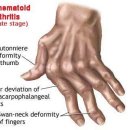 루푸스+류마티스관절염 치료경과와 자가면역조절 (1) 이미지