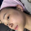 레이저솔루션 | 좁쌀 압출 후 붉은 여드름자국 레이저 추천/2주후기