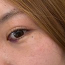 하단 성형외과 파셀라 윤곽주사 애교필러 후기