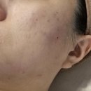 토탈메디케어 | [ 문화동에스테틱 보나메디스킨&amp;보나헤어살롱 문제성 피부 맞춤 관리 후기 ]