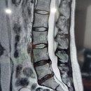 서진한의원 | 허리디스크 극복 일기1(허리디스크 4번, 5번, 요추 1번)