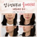 압구정피부과 울쎄라피 내돈내산 후기｜심부볼(불독살)·이중턱 리프팅 비포애프터