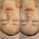 예손헤어라인 | [관리후기] 광주 얼굴 축소 리프팅으로 목주름 관리하고 온 후기 : 예손피부