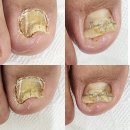 세븐일레븐 대림88타워점 | 대림역내성발톱 두꺼워지고 말린 발톱 이렇게 해결했어요 네일샵에스대림점