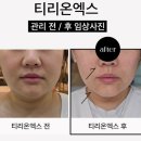 세븐엘레븐 앞 | [학동/청담] 엘바이세븐 티리온엑스 피부관리 후기(티리온vs온다 차이)