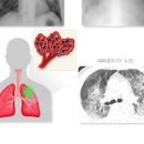 폐에 물이 차면 나타나는 증상과 치료 물이차는 이유 폐물참 의심 질환(폐부종 폐수종) 이미지