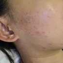 다뽑자 | 동탄피부관리 추천 &#39;뽑자슈가링 스킨리포어&#39; 동탄점 여드름 압출 솔직후기