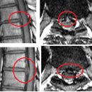 easy 님의 흉추디스크 T4-5, T7-8 밑 기타 척추부위 MRI사진 판독입니다. 이미지