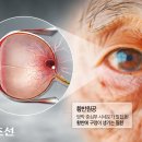 노안인줄 알았는데, 눈 중심부에 구멍 뚫리는 질환? 놔두면 실명… 의심 증상은? 이미지