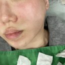 삼성하나약국 | 삼성중앙역 포텐자 펌핑 쥬베룩 스킨부스터 1차, 삼성동 블룸쥬베룩 후기