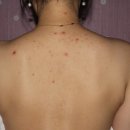 대성한의원 | 대구 등여드름 치료와 등드름 자국 미세약초침 치료 후기