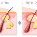 더맑은아크네뷰티