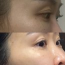 밝은햇살한의원 | 서울편평사마귀무제한 성지 후기 명동에서 편사 제거 과정 전후비교