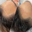 미헤어라인 이미지
