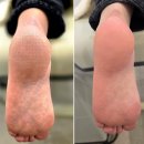 레푸스원주점 | 원주 발각질 제거 추천 – 레푸스 원주점 실제 후기 & 케어