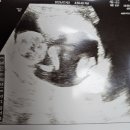 세븐일레븐 울산다운드림점 | 임신일기) 12주-19주 울산 보람병원 다운증후군 고위험군 양수 검사 후기