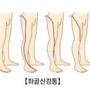 좌골신경통 및 , 스트레칭 (허리 엉덩이 통증, 급성 요통) 이미지