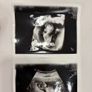 서울유산부인과의원 | [임신9주, 11주] 불안한 임산부 평택 서브 산부인과 서울유산부인과