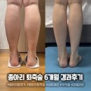 종아리알 고민 끝! 종아리퇴축술 6개월차 솔직 후기와 유지 비법