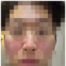 더채운한의원 | 노원여드름흉터 노원새살침 4회차 후기, 노원구한의원 패인흉터 기록