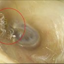 "귀 안에 저게 뭐야?"…바스락거리는 소리 거슬려 병원 갔더니 이미지