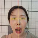 입선한의원 | 송파 안면비대칭 한의원 방문 후기, 얼굴 중심이 달라진 느낌?
