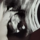 광교은산부인과의원 | 14주차 초음파 입체초음파 성별확인 | 광교은산부인과