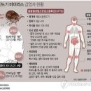 부산서 '야생진드기' 의심환자 치료중 사망(종합) 이미지