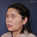 하얀미의원 | 불독살제거, 안면거상만 해도 가능한가요?