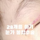 신촌홍대 라마르성형외과의원 | 28개월 아기 눈가 찢어짐 봉합수술 후기 및 보험처리까지(+1년 후 흉터자국)