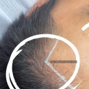 선헤어라인 이미지