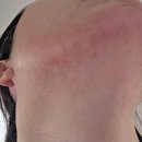 천상열내과의원 | 두릅 알러지 의심으로 내과 다녀온 후기, 얼굴에서 몸통까지 번진 두드러기 기록