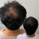 비바헤어 - 남동구 | 별내동 두피문신 후기 | 정수리 휑함, 비바헤어에서 이렇게 채웠어요