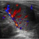 Malignant uterine and cervical lesions 이미지