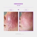 메이비의원 | 천안 여드름 모공 홍조 기미 잡는 플라모듀 관리 오픈 | 천안 플라모듀 런칭 이벤트 공개