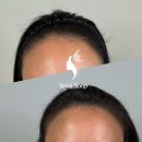 대화역(3호선) | 3호선 대화역 일산 백병원 근처 두피문신, 달라진 헤어라인 하나로 인생이 바뀌었어요