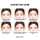 다정교 | #4 내시경 이마거상술 후기, 내시경 이마거상술 흉터 최소화를 위한 정교함 &#34;작은 절개, 큰 변화&#34;