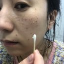 (주)한국클라리티 | 피부과일기 #15. 레이저토닝 3회로 대만족한 내돈내산 후기 (클라리티, 듀얼악센토)