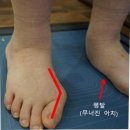 인포메디 | 무지외반증 교정 후기, 교정기와 깔창 진짜 효과 있나?