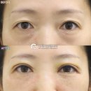 지제이(GJ)성형외과의원 | 불룩한 지방을 깔끔하게 탄력 있는 눈 밑을 만드는 지제이 눈밑지방재배치