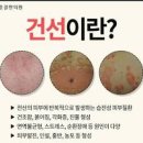 독감 증상 치료 독감과 감기 차이 예방법 이미지