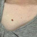 영광한의원 | 한의원에서 돌출점 왕점 피침요법으로 뺀 후기