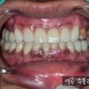 소사치과의원 | 부천소사역곡치과 "이가 다 흔들려요" 최대한 치아를 살려서 치료한 후기