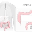 대장암 유발하는 '궤양성 대장염' 10년새 3.8배 늘었다 이미지