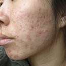 이조한의원 | “뉴에어프락셀 9회차 후기 – 울트라펄스앙코르, 에어서브시전, CPG 흉터조각술, 프락셀듀얼 조합으로...