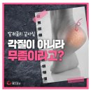 발뒤꿈치 갈라짐, 각질이 아니라 무좀 이미지