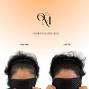 대구SMP | 대구smp 대구두피커버 온미SMP대구 솔직 후기