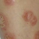 미로서면한의원 | [공지] [난치성 피부질환의 치유모습]을 정리하는 이유