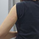 진상의원 | 안양범계 팔뚝 다이어트 주사 당일 후기 (DCA 지방파괴 주사)